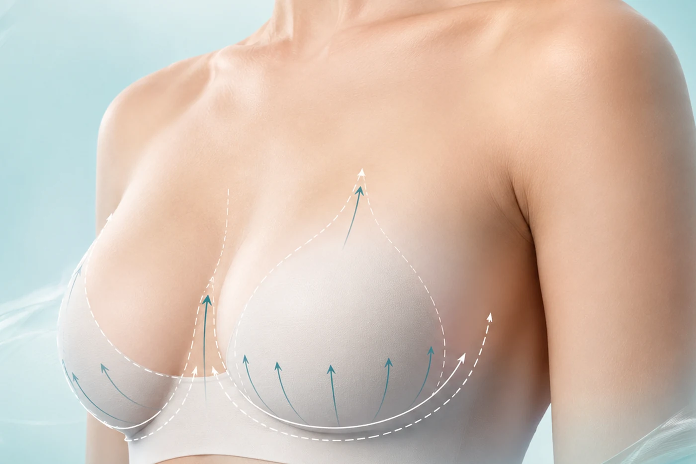 Breast Lift