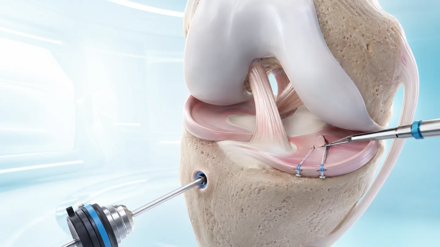 Meniscus Repair
