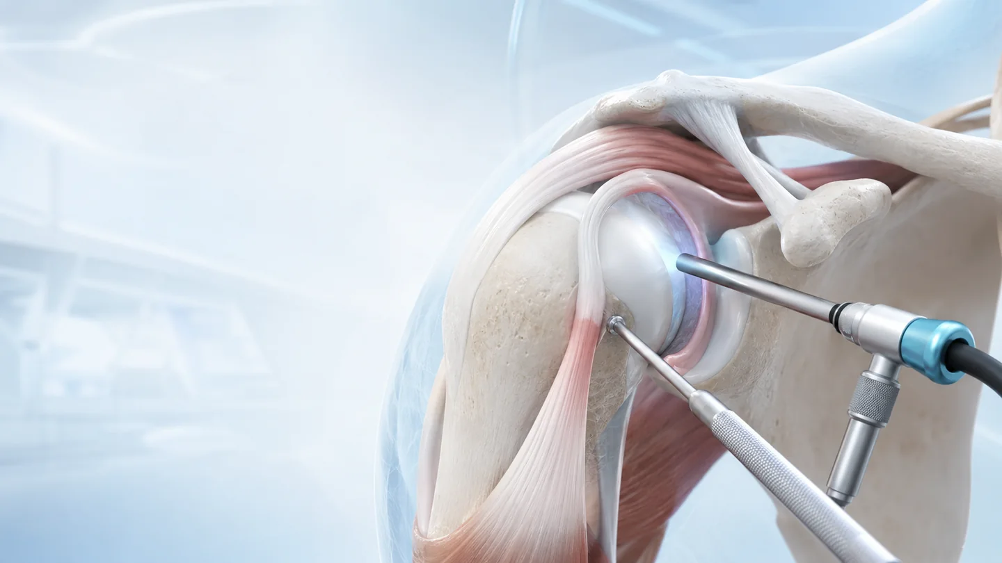 Shoulder Arthroscopy