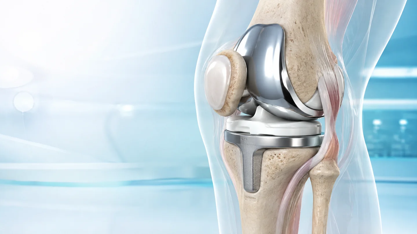 Total Knee Replacement