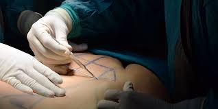 Stretch Mark Reduction