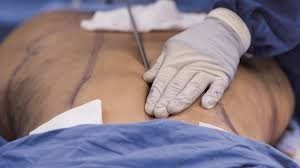 Personalized Surgical Planning