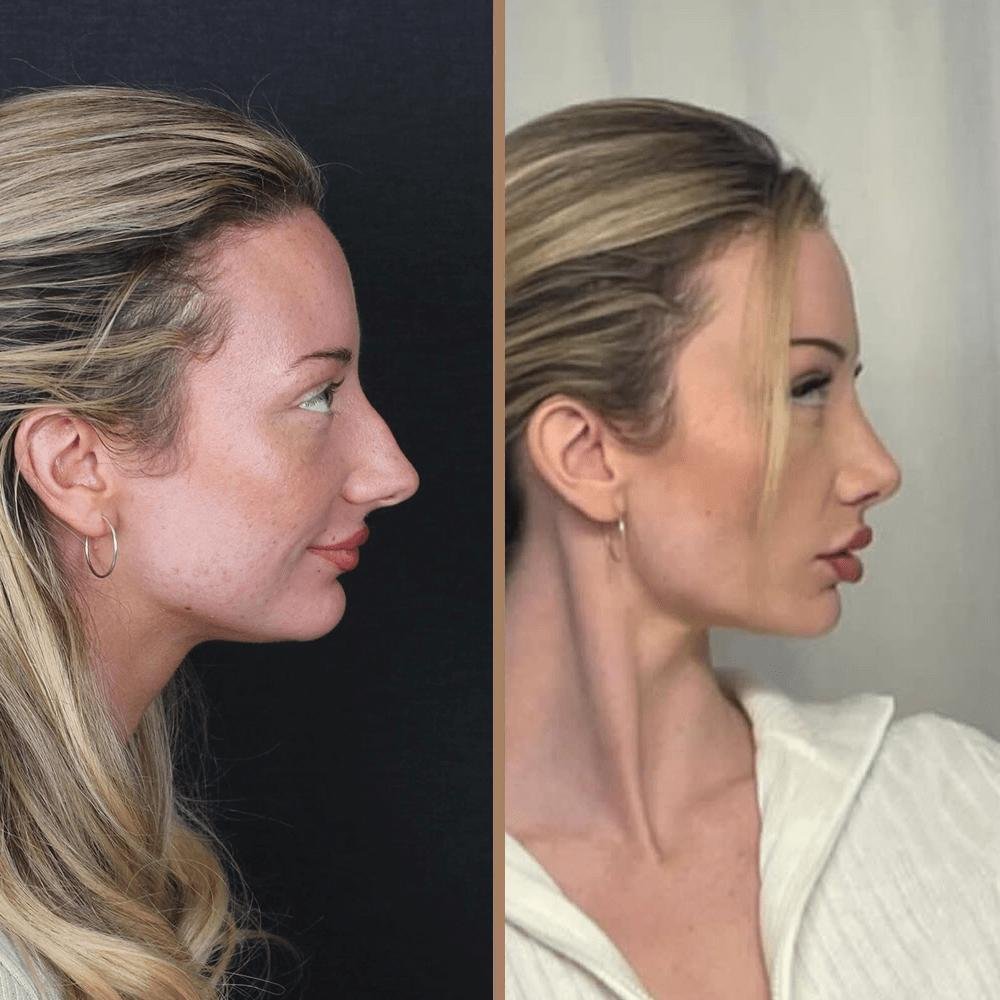 Customized Nose Reshaping
