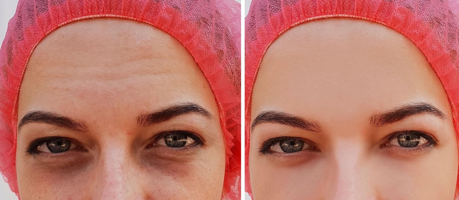 Puffiness and Bag Reduction