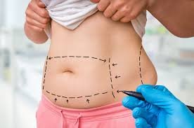 Abdominoplasty